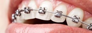 علل بالقوه TMJ ناشی از ارتودنسی