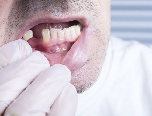چه زمانی دندان ها باید کشیده شوند؟