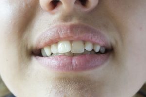 آیا بعد از بریس ها دندان ها به عقب برمی گردند؟