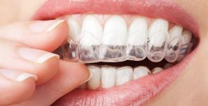 چگونه از جابجایی دندان های خود پس از بریس ها جلوگیری کنیم؟