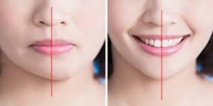 عدم تقارن صورت را چگونه توصیف می کنید؟