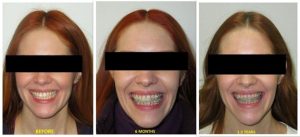 چه چیزی باعث ایجاد صورت نامتقارن می شود؟