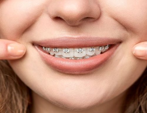 آیا بریس ها می توانند فک را متقارن کنند؟
