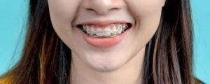 چه زمانی ریتینرها می توانند دندان های شما را دوباره مرتب کنند؟