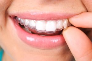 نشانه هایی که نشان می دهند برای دفعه دوم به بریس ها نیاز دارید؟