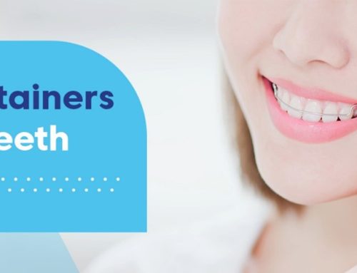 آیا ریتینرها می توانند دندان های جابجا شده دوباره به جای خود برگردانند؟