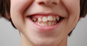 پیش نیازهای سلامت دندانی برای بریس ها