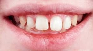 چه چیزی شما را از دریافت بریس ها محروم می کند؟