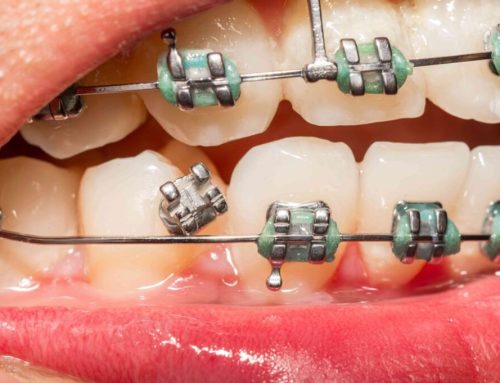 علل و اقدامات لازم در موارد کنده شدن چسب براکت ارتودنسی