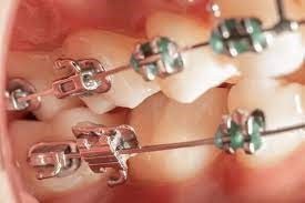 اگر چسب براکت ارتودنسی جدا شود چه اتفاقی می افتد؟