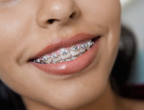 آیا لب ها بعد از بریس ها متفاوت به نظر می رسند؟