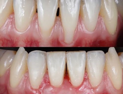 مراحل تحلیل لثه به چه صورت هستند و چرا اتفاق می افتند؟