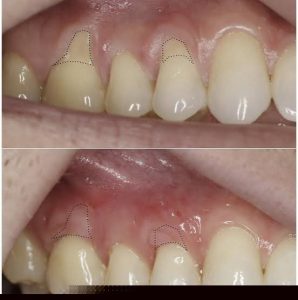 علل و عوامل خطر برای تحلیل لثه