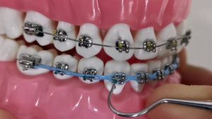 آیا جدا شدن رابر بند از بریس ها مسئله مهمی است؟