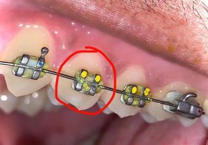 اگر لیگاچور بریس های شما جدا شود چه باید کرد؟