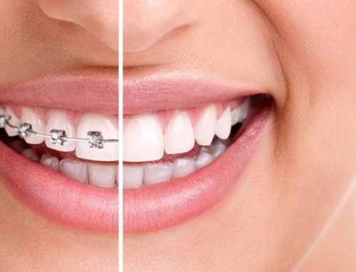 بعد از برداشتن بریس هایتان چه اتفاقی می افتد؟