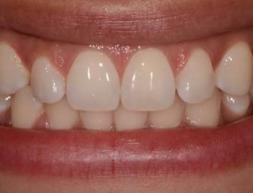 دندان ها در حالت استراحت باید چگونه قرار بگیرند؟