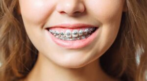 بریس های خود تنظیم شونده چیستند؟