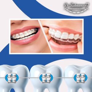 بریس های سرامیکی یا شفاف