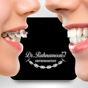 چه عواملی باعث به هم نرسیدن لب ها یا کشیدگی منتالیس می شوند؟