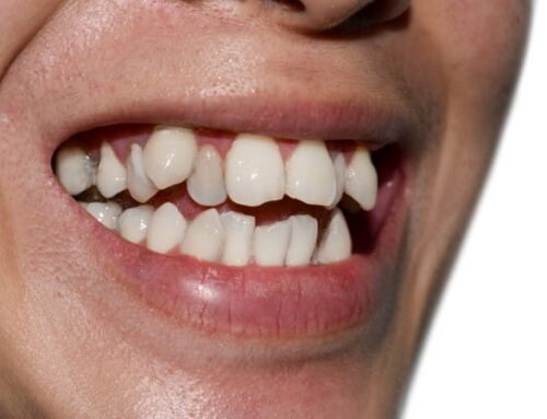 چگونه بایت با دندان های زیاد را اصلاح کنیم؟