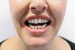 پیامدهای کلیدی ناشی از دندان های کج