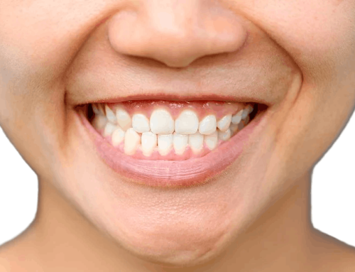 دلایل اصلی حرکت دندان ها پس از ارتودنسی و آنچه می توانید در مورد آن انجام دهید