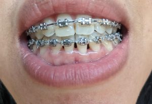 چه چیزی باعث از بین رفتن پاپیلای بین دندانی می شود؟